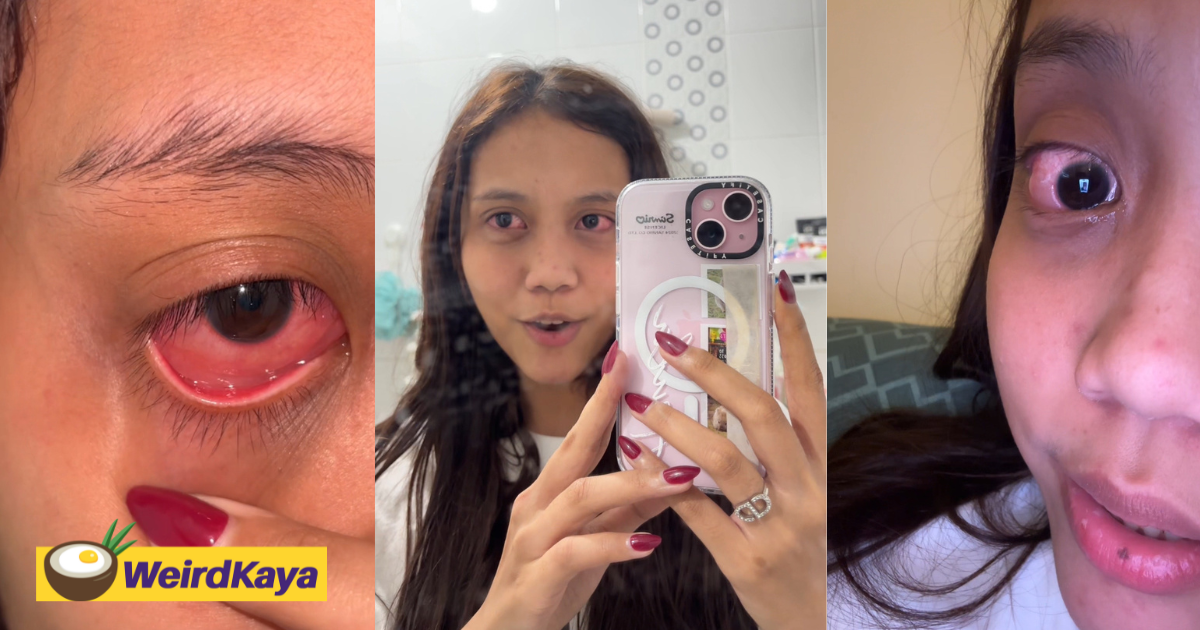 M'sian woman's eyes become severely swollen after using contact lenses she bought on tiktok shop | weirdkaya