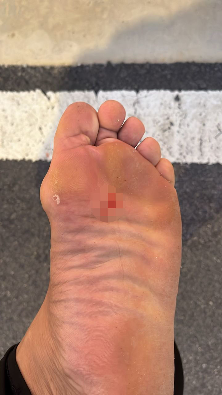 Man's foot bleeding poked by nails while jogging