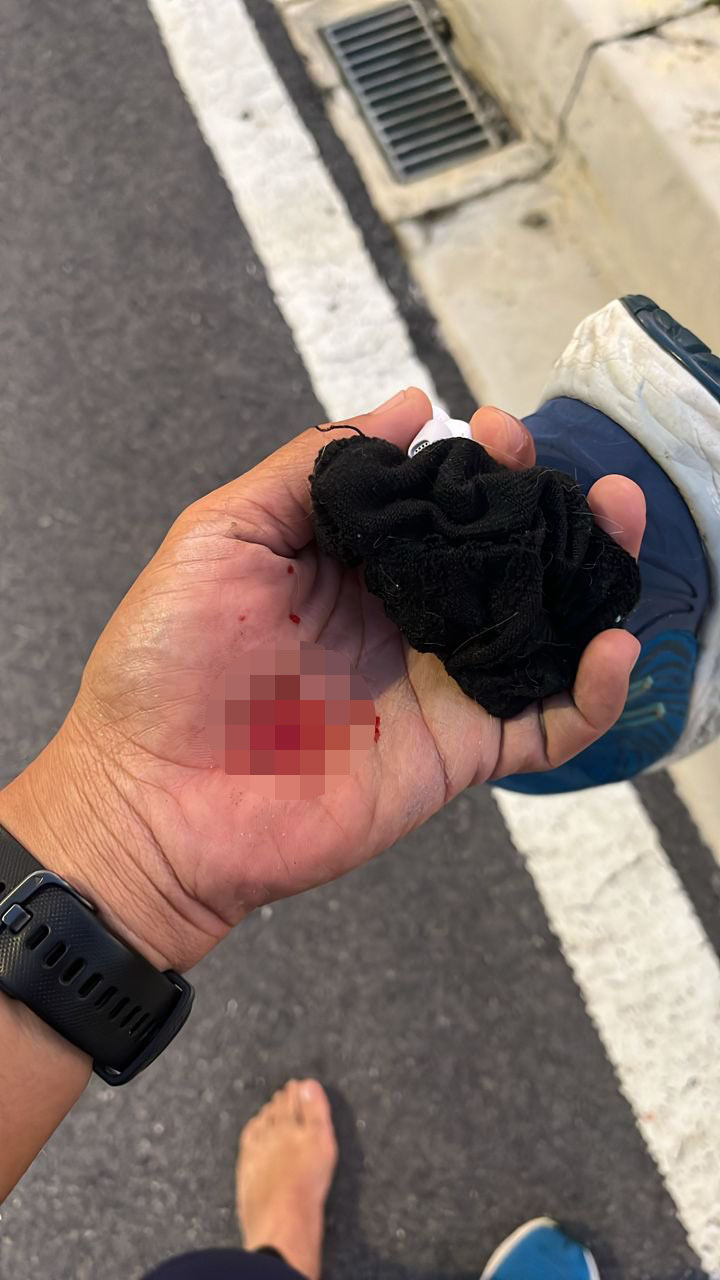 Man's palm bleeding poked by nails while jogging