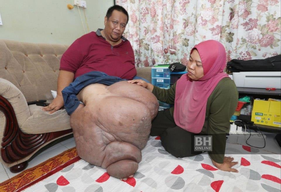 Mohd zulkifli zainal showing his swollen right leg