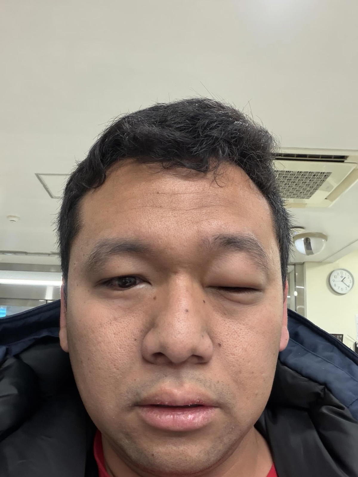 M’sian Suffers Severe Allergic Reaction After Eating Seafood In S. Korea, Racks Up RM1,500 ER Bill