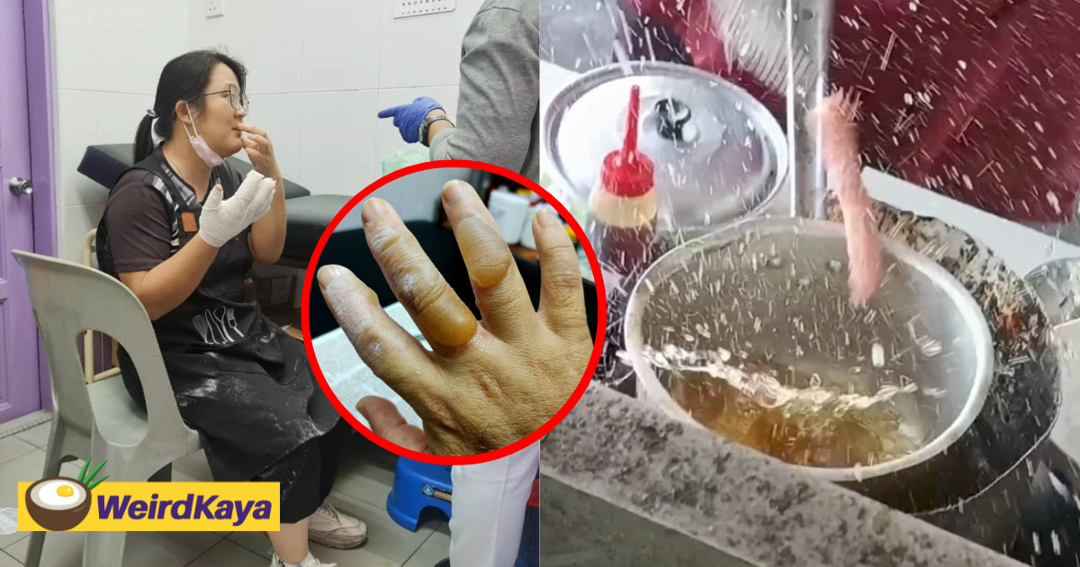 M’sian woman suffers burns after sausage ‘explodes’ inside frying pan | weirdkaya