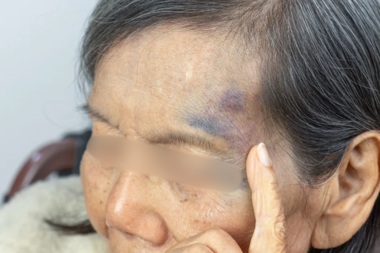 old woman with bruises