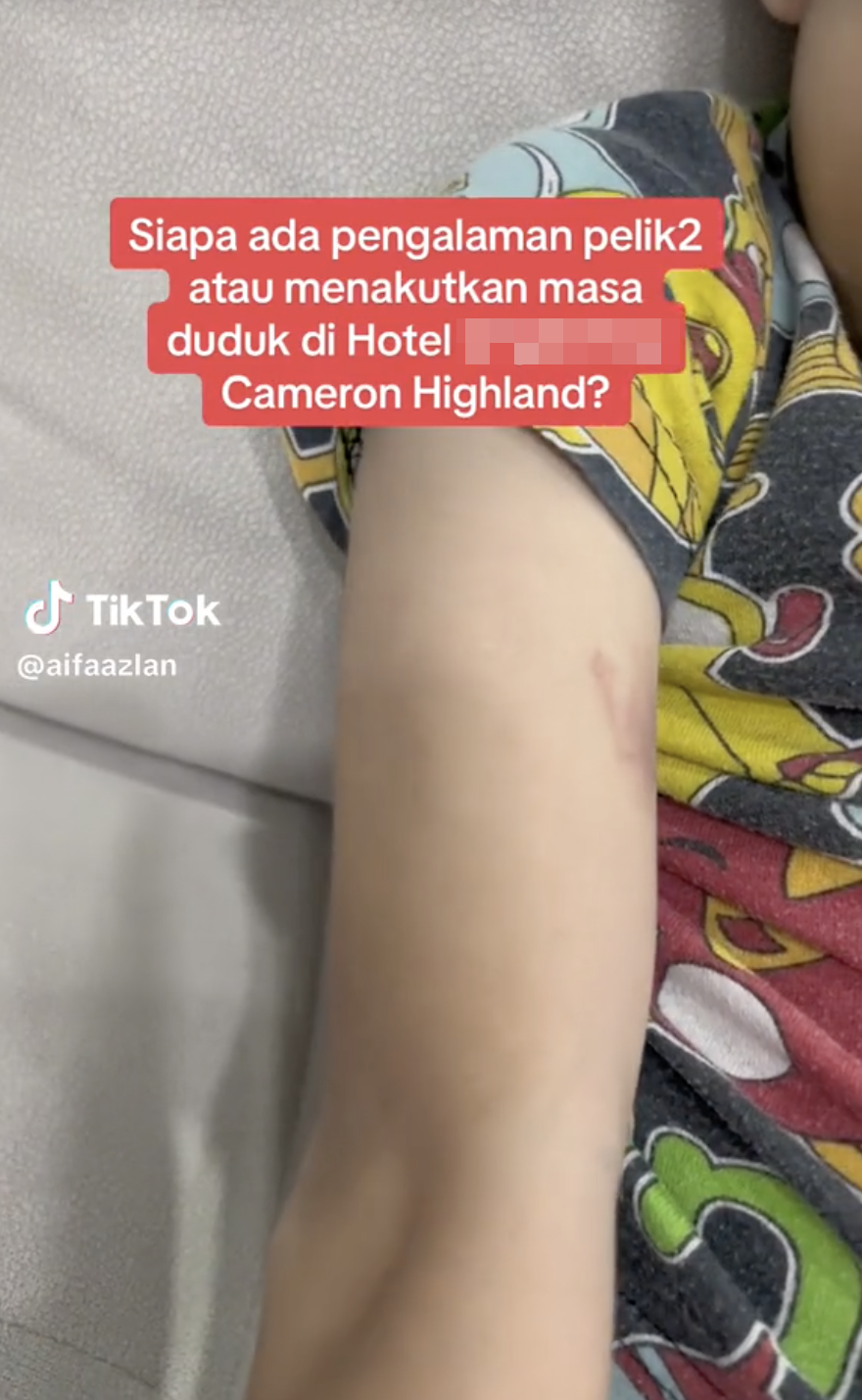 M'sian mother says bruises appeared on son's arm after staying at cameron highlands, claims it's a paranormal event | weirdkaya