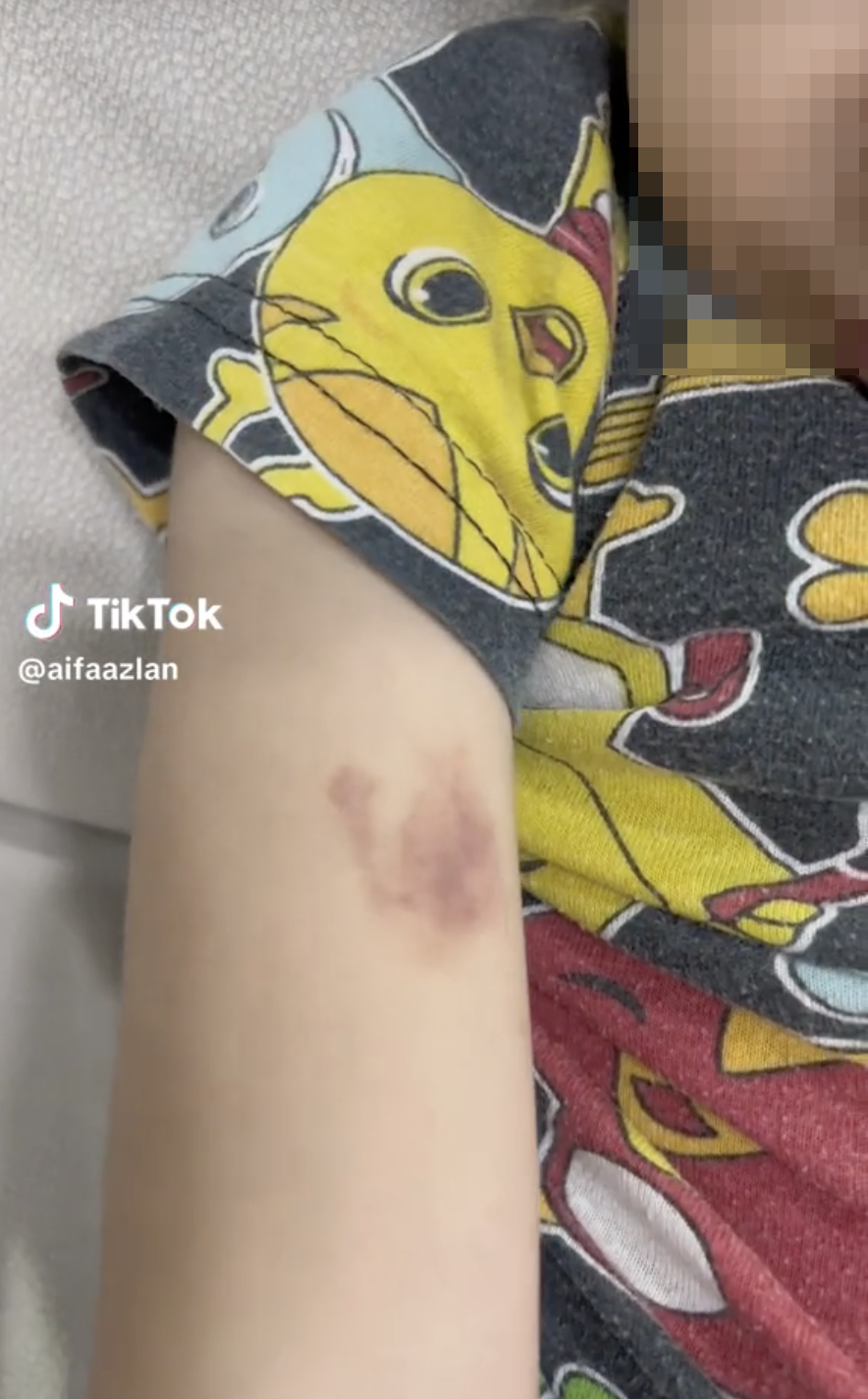 M'sian mother says bruises appeared on son's arm after staying at cameron highlands, claims it's a paranormal event | weirdkaya