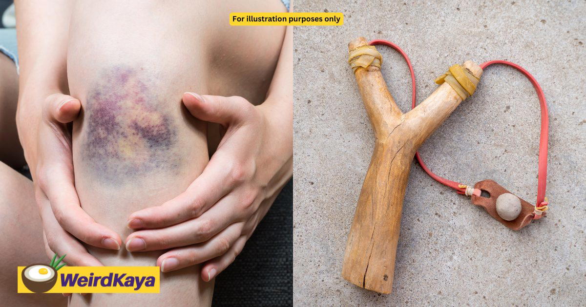 Chinese Tourist Hit By Object Flung From Slingshot In Sabah, Sustains Bruises To Her Body