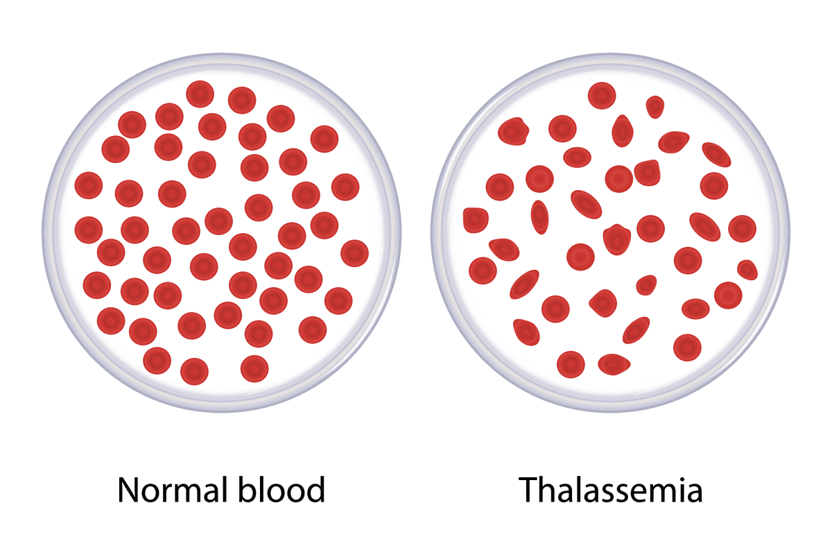 Example of thalassemia blood cells