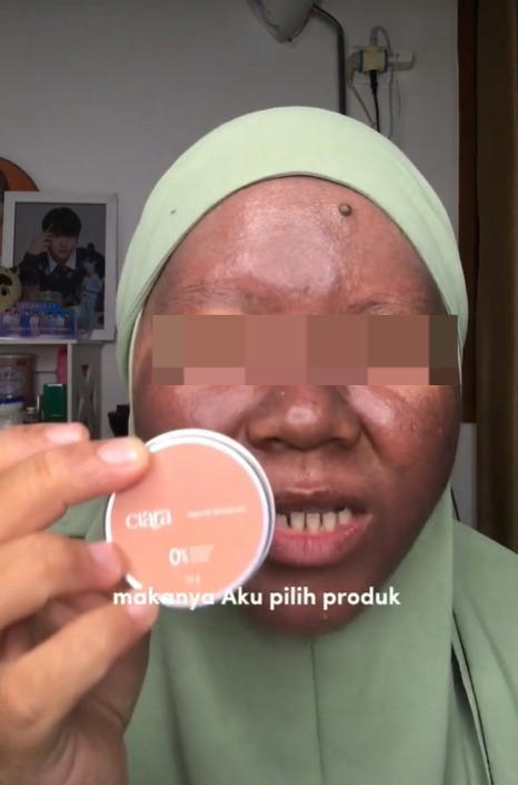 M'sian woman's skin turns dark after using mercury-containing whitening skincare products