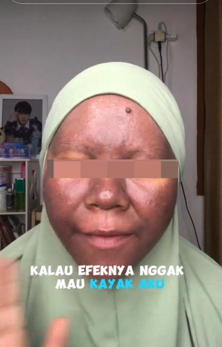 M'sian woman's skin turns dark after using mercury-containing whitening skincare products