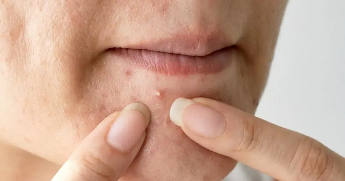 woman popping acnes