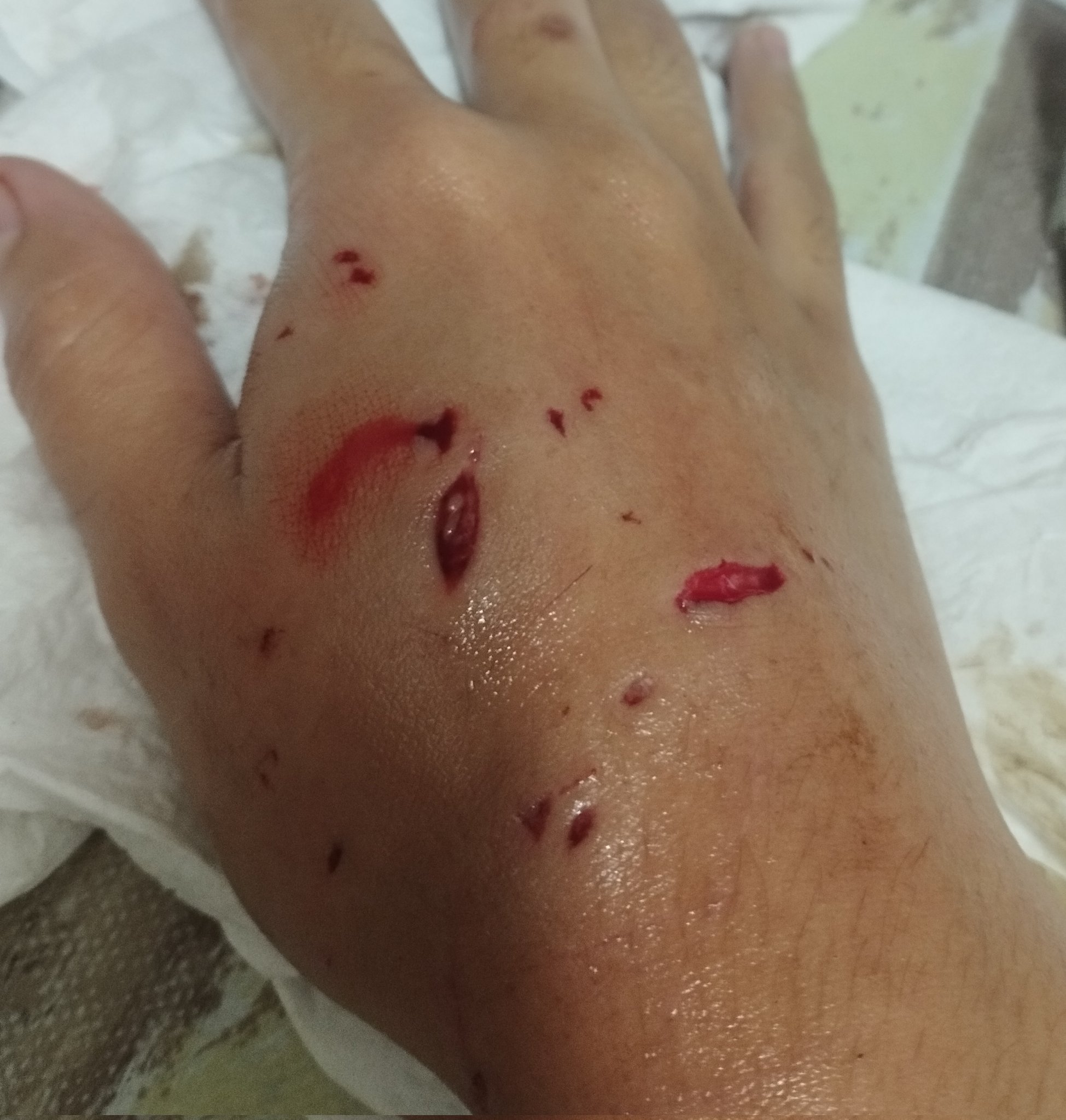 Woman's hand injured by pet cat