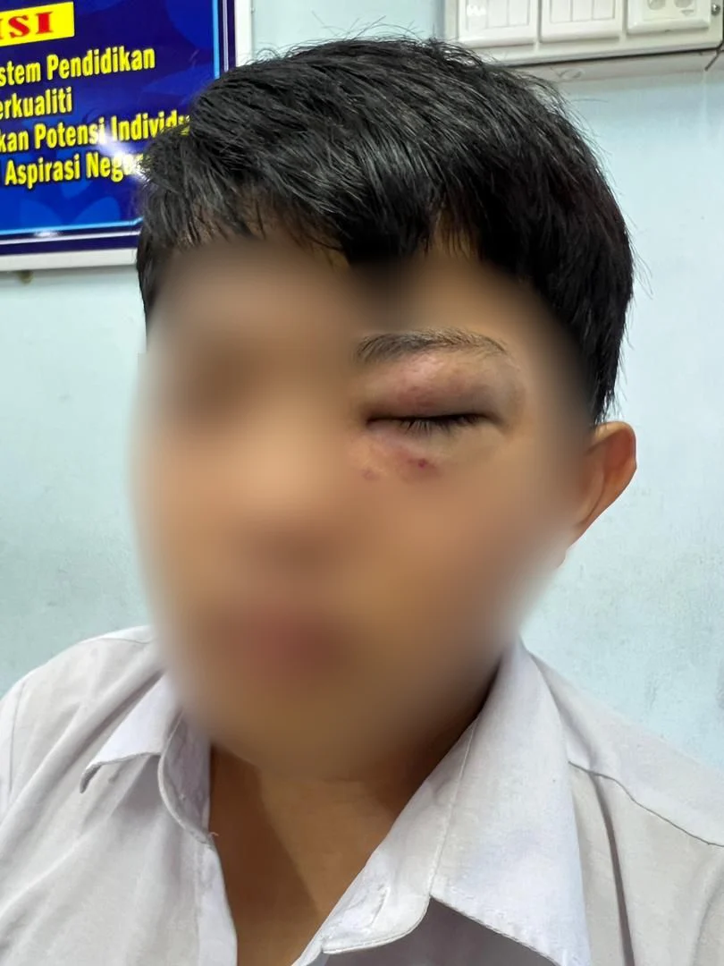 Zheng's son having a bruised eye